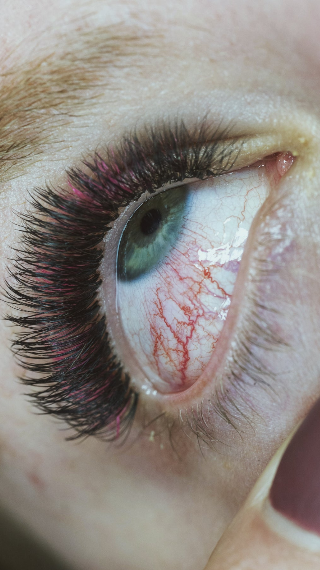 Chemical burn vs. pad irritation photo of a red eye.