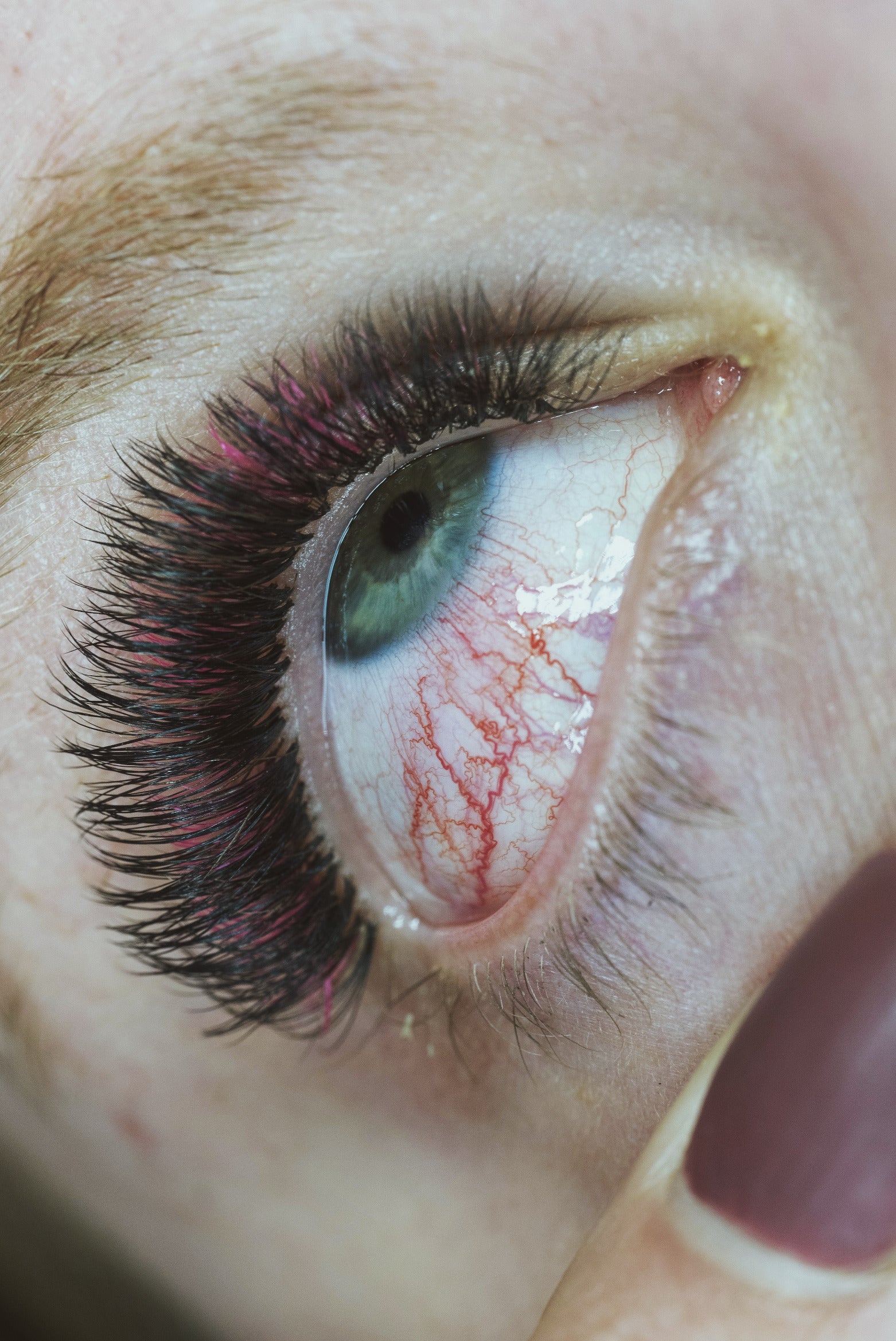 Chemical burn vs. pad irritation photo of a red eye.