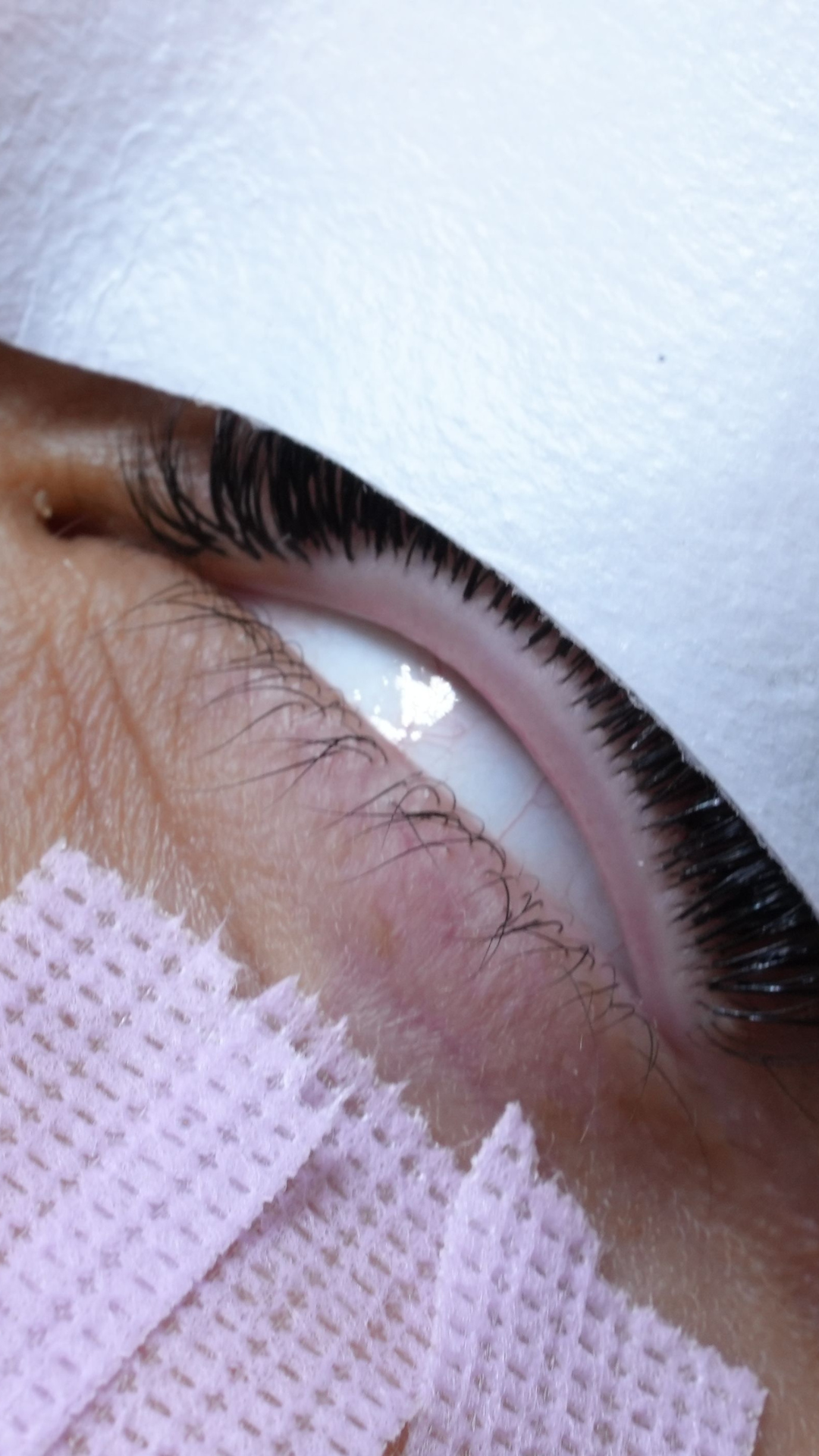 Client eye slightly open during a lash extension service with under eye pad in place showing visible redness from chemical burn irritation.