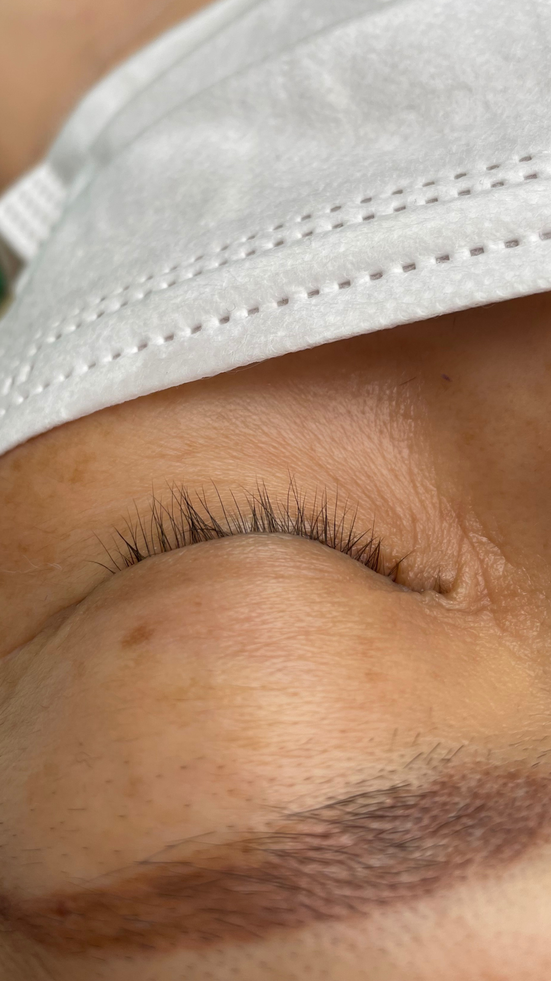 Close up of a closed eye with a face mask partially visible, showing weak natural lashes with fine, sparse growth along the lash line.